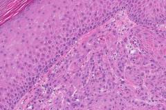 Squamous cell carcinoma of the skin