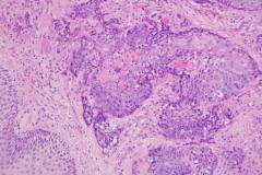 Squamous cell carcinoma of the vagina