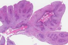 Squamous papilloma of the oral cavity