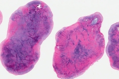 Synovial chondromatosis