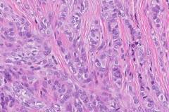 Biphasic synovial sarcoma