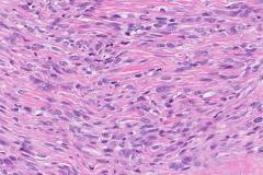 Biphasic synovial sarcoma