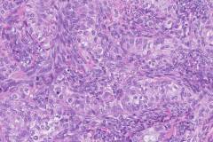 Biphasic synovial sarcoma