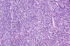 Biphasic synovial sarcoma