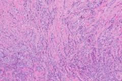Biphasic synovial sarcoma