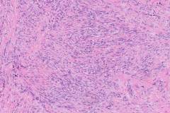 Biphasic synovial sarcoma
