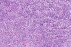 Biphasic synovial sarcoma