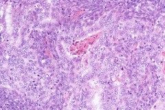 Biphasic synovial sarcoma