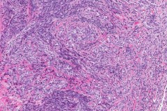 Biphasic synovial sarcoma