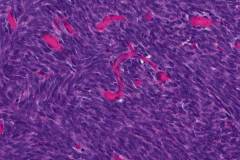 Monophasic spindle cell synovial sarcoma