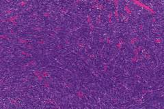 Monophasic spindle cell synovial sarcoma