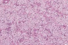 Tenosynovial giant cell tumour, diffuse type