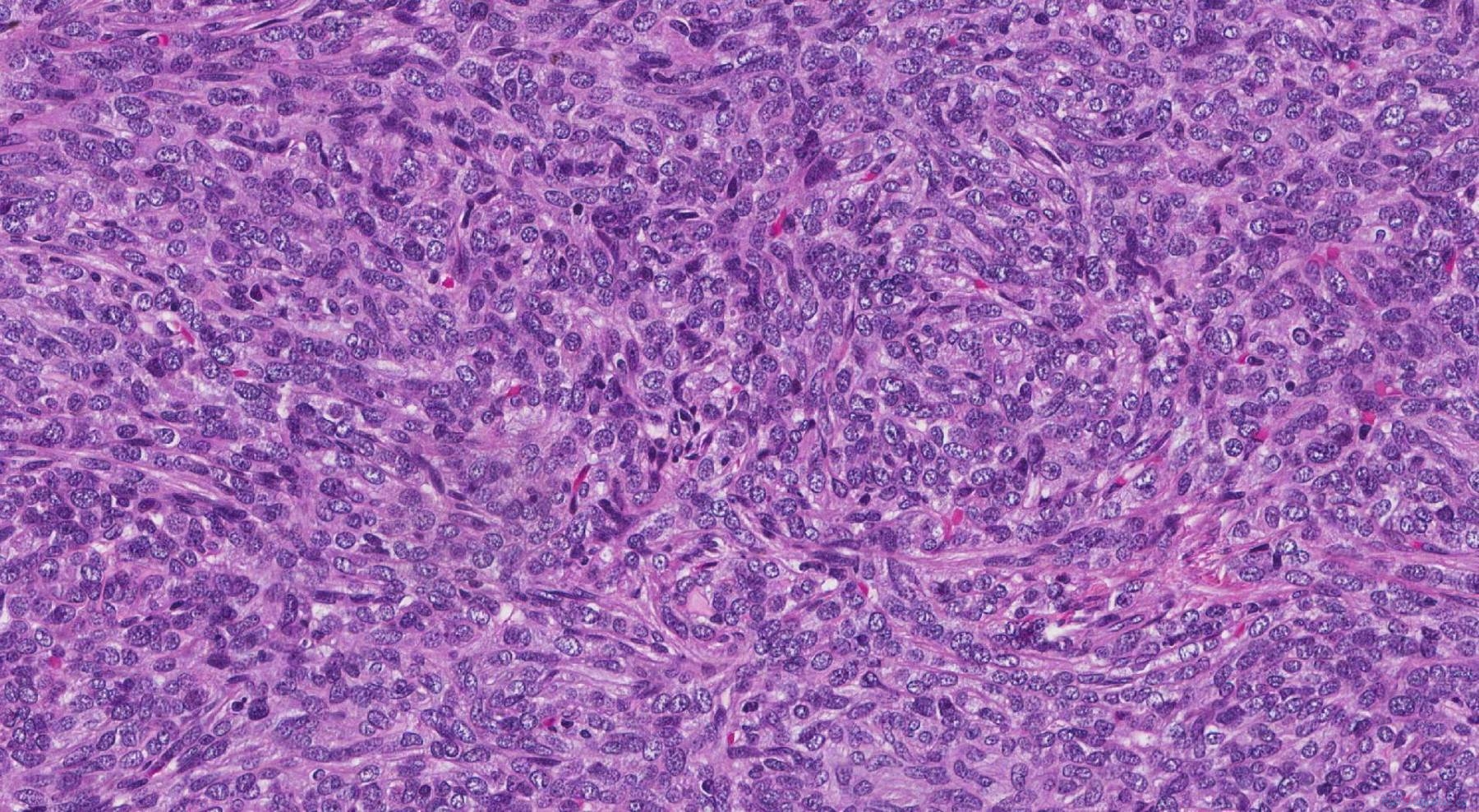 Thymoma Type A Atlas Of Pathology