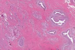 Thyroglossal duct cyst