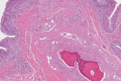 Thyroglossal duct cyst