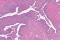 Thyroglossal duct cyst