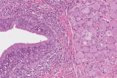 Thyroglossal duct cyst