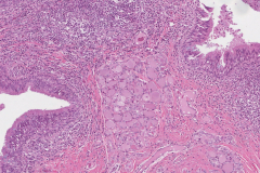 Thyroglossal duct cyst