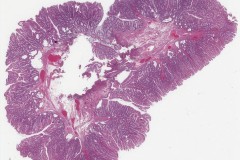 Traditional serrated adenoma