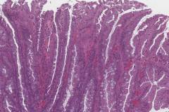 Traditional serrated adenoma
