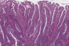 Traditional serrated adenoma