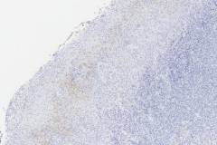 Treponema infection of the oropharynx