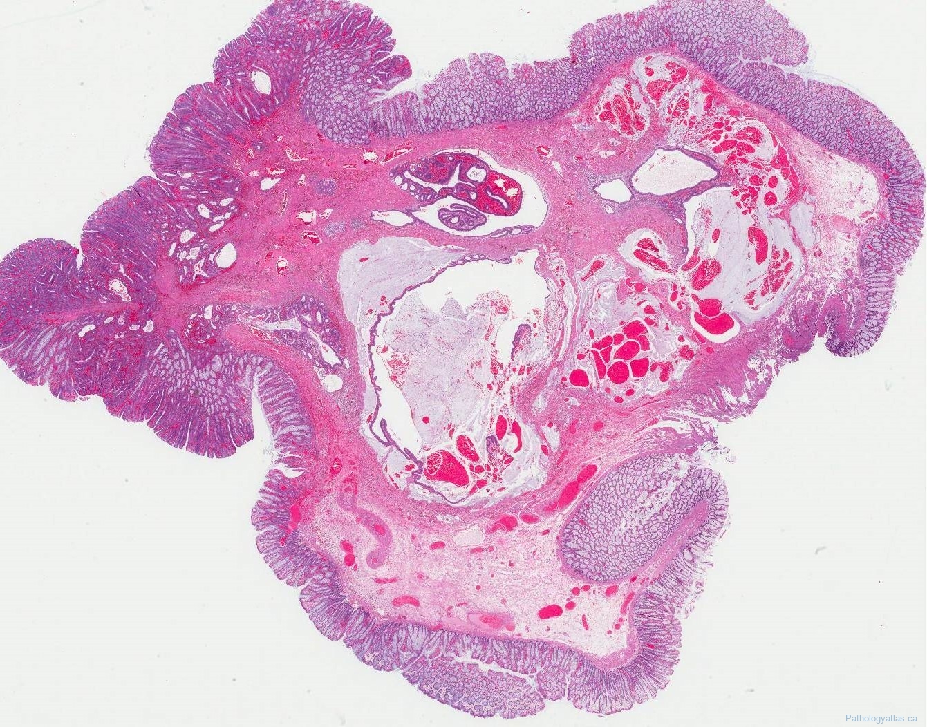 Tubular adenoma of the colon atlas of pathology