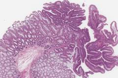 Tubulovillous adenoma and hyperplastic polyp in the rectum