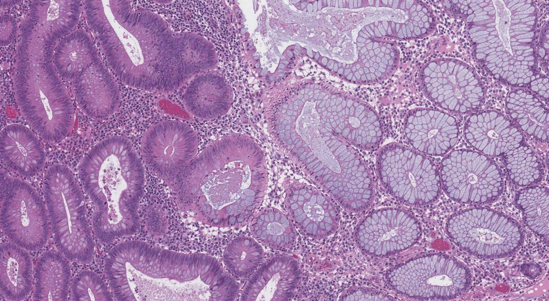 Tubular adenoma of the colon atlas of pathology