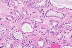 Tubulocystic carcinoma of the kidney