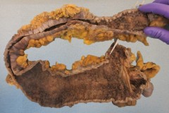 Ulcerative colitis