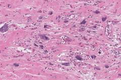 Post radiation undifferentiated pleomorphic sarcoma