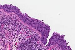 Urothelial carcinoma in situ of the bladder