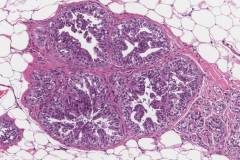 Usual ductal hyperplasia of the breast