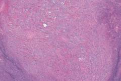 Uterine tumour resembling ovarian sex cord tumour