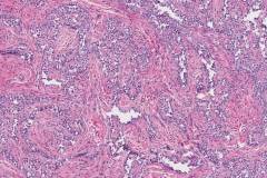 Uterine tumour resembling ovarian sex cord tumour