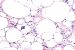 Well differentiated liposarcoma
