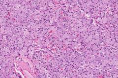 Well differentiated neuroendocrine tumour of the pancreas