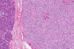 Well differentiated neuroendocrine tumour of the pancreas