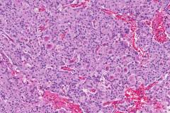 Well differentiated neuroendocrine tumour of the pancreas