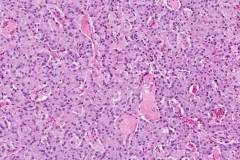 Well differentiated neuroendocrine tumour of the pancreas