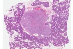 Well differentiated neuroendocrine tumour of the pancreas