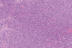 Well differentiated neuroendocrine tumour of the pancreas