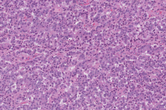 Well differentiated neuroendocrine tumour of the pancreas
