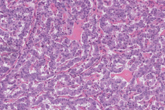Well differentiated neuroendocrine tumour of the pancreas