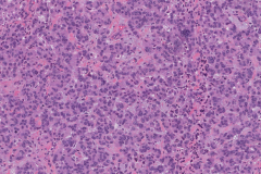 Well differentiated neuroendocrine tumour of the pancreas