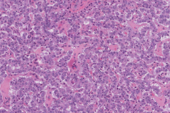 Well differentiated neuroendocrine tumour of the pancreas