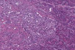 Well differentiated neuroendocrine tumour of the pancreas
