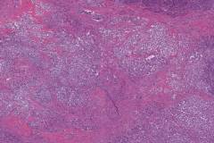 Well differentiated neuroendocrine tumour of the pancreas