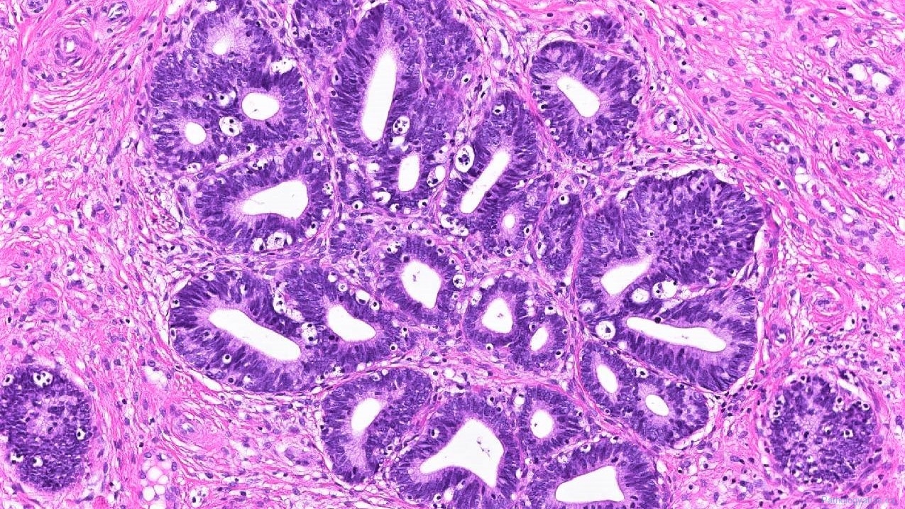 Cervix Atlas Of Pathology